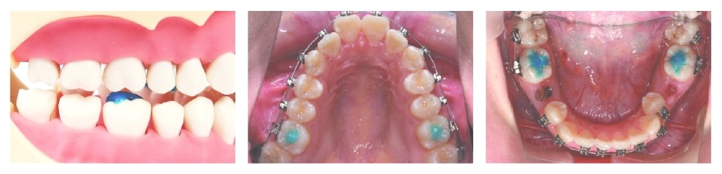 Band Zement "BLUE" Set