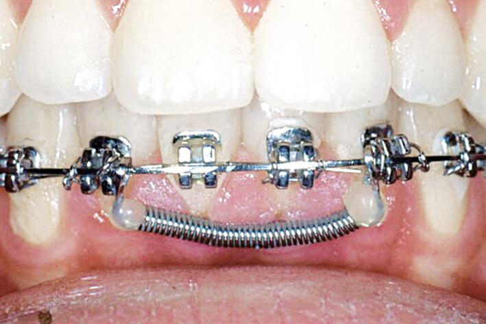 Huckepackfeder Einzelbox B1, orange