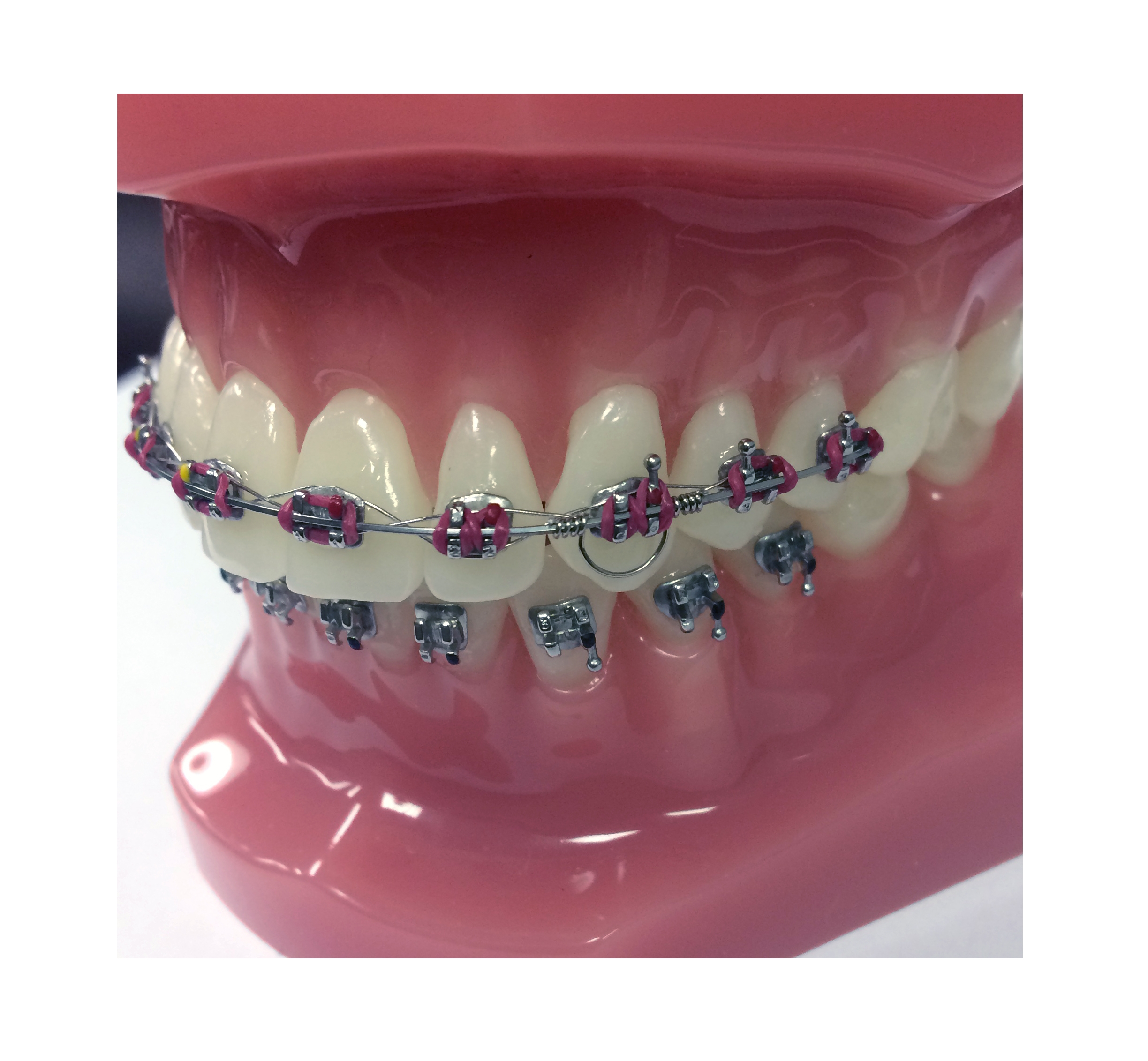 GTS - Goodman Torquing Spring Set