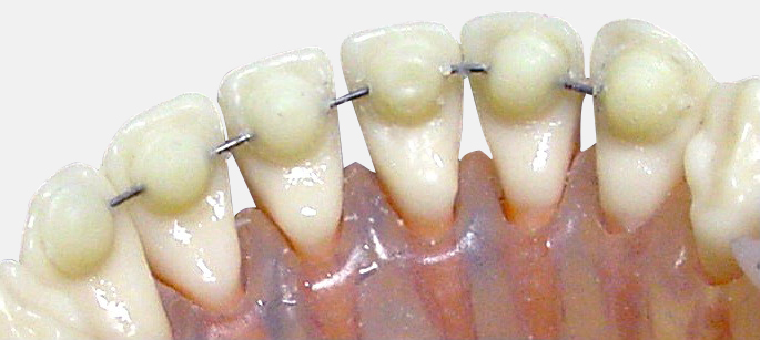 Mini Mold® Universal Bite Opening Kit