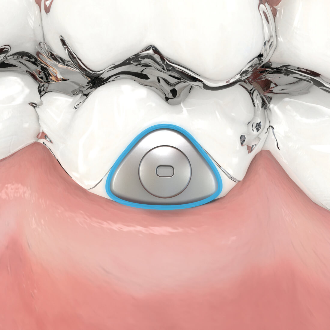 Aligner Buttons, transparent